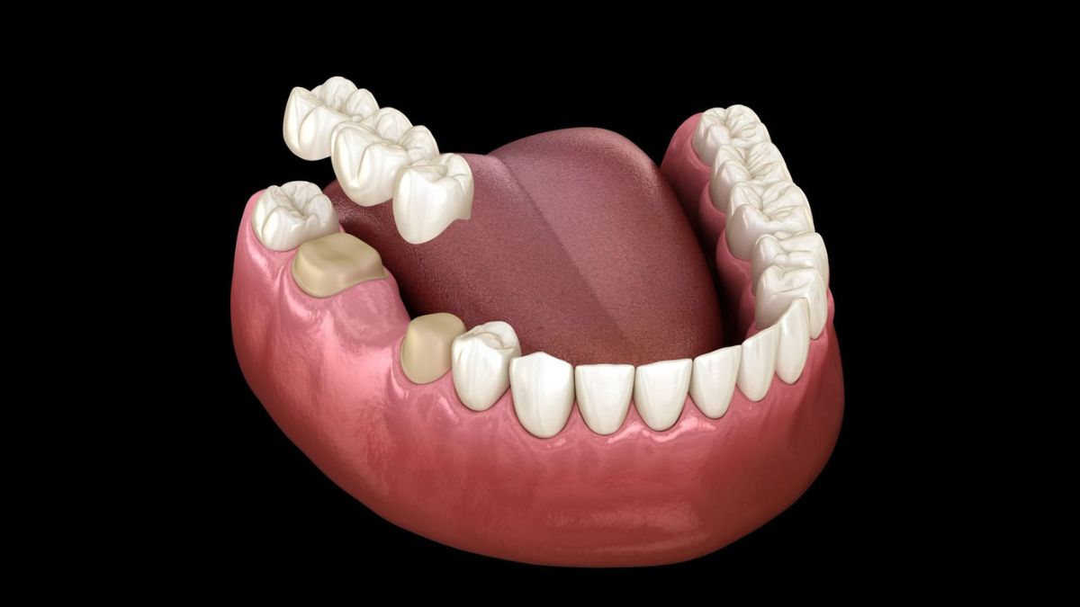Dental Crowns